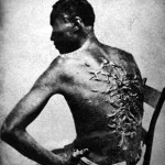 Scars of a whipped Mississippi slave.