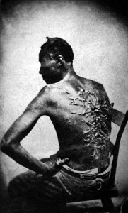 Scars of a whipped Mississippi slave.
